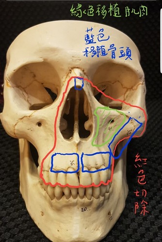 大破壞後的重建，要維持麥可左眼、鼻部呼吸、口腔功能和外觀外，如何拼湊被腫瘤吃掉留下巨大傷口，整形暨重建外科主任李俊達與團隊為麥可進行眼眶顴骨複合區結構重建，重建被腫瘤吃掉的顴骨、上顎鼻竇與上顎齒槽骨，首次手術時間就長達十九個小時