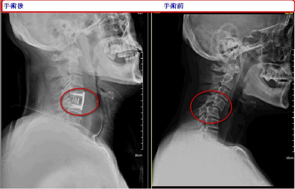 頸椎脫位快就醫　復位手術救神經