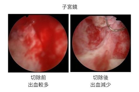 流產後持續出血　小心胎盤殘留