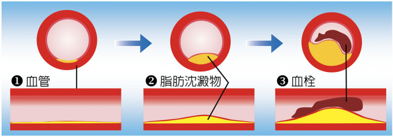 冠狀動脈粥狀血管硬化過程，1.正常動脈 2.形成動脈硬化血塊 3.被血塊阻塞的動脈
