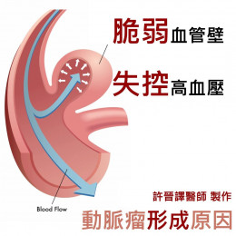 花蓮慈院高齡整合照護科主治醫師許晉譯分享動脈瘤形成的主要原因。