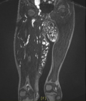 磁振造影檢查（MRI），可以看出小班克的右腿比左腿大，是罕見的「動靜脈血管畸形」合併「微血管畸形」，其中動靜脈血管畸形瘤已成為拳頭大小，垂掛在鼠蹊部與右腿間，已經影響到如廁及行動。