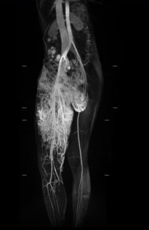 磁振造影檢查（MRI），可以看出小班克的右腿比左腿大，是罕見的「動靜脈血管畸形」合併「微血管畸形」，其中動靜脈血管畸形瘤已成為拳頭大小，垂掛在鼠蹊部與右腿間，已經影響到如廁及行動。