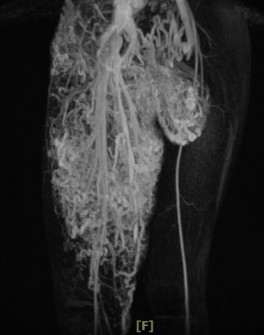 磁振造影檢查（MRI），可以看出小班克的右腿比左腿大，是罕見的「動靜脈血管畸形」合併「微血管畸形」，其中動靜脈血管畸形瘤已成為拳頭大小，垂掛在鼠蹊部與右腿間，已經影響到如廁及行動。